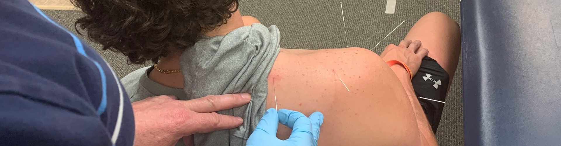 Dry Needling